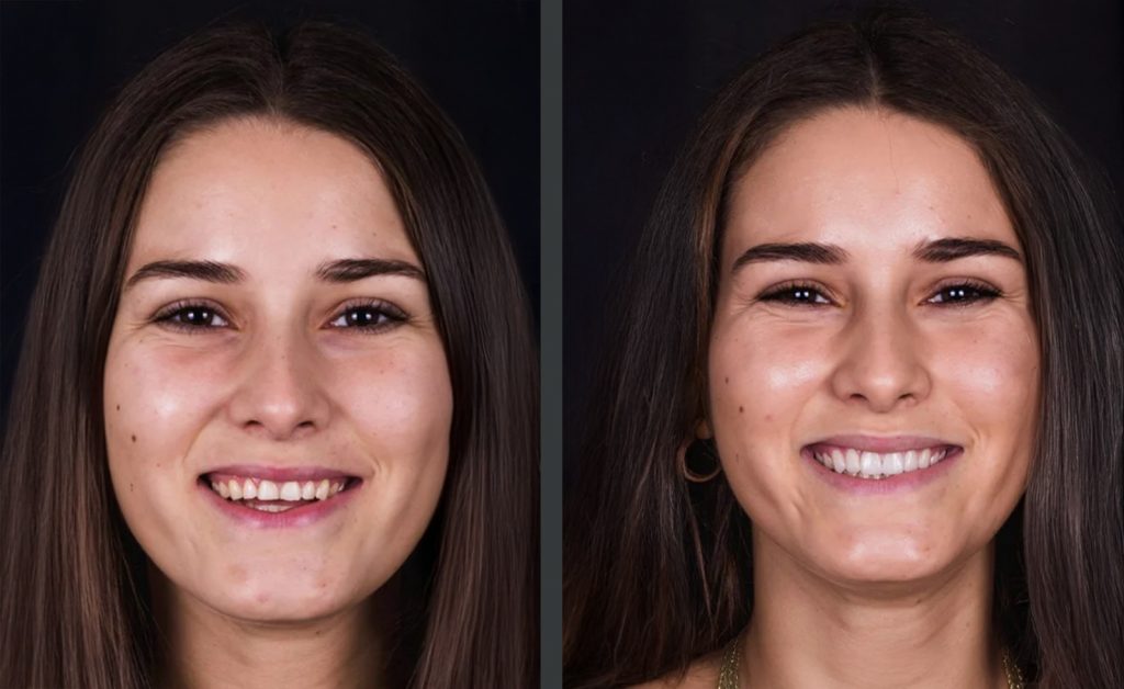 Antes Y Después Carillas