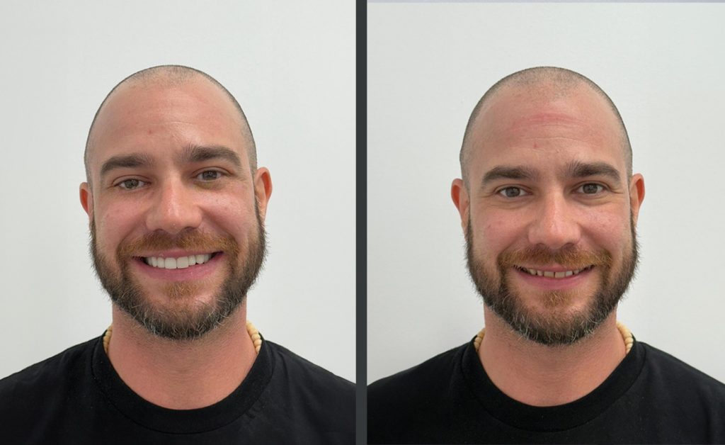 Antes Y Después Carillas 2