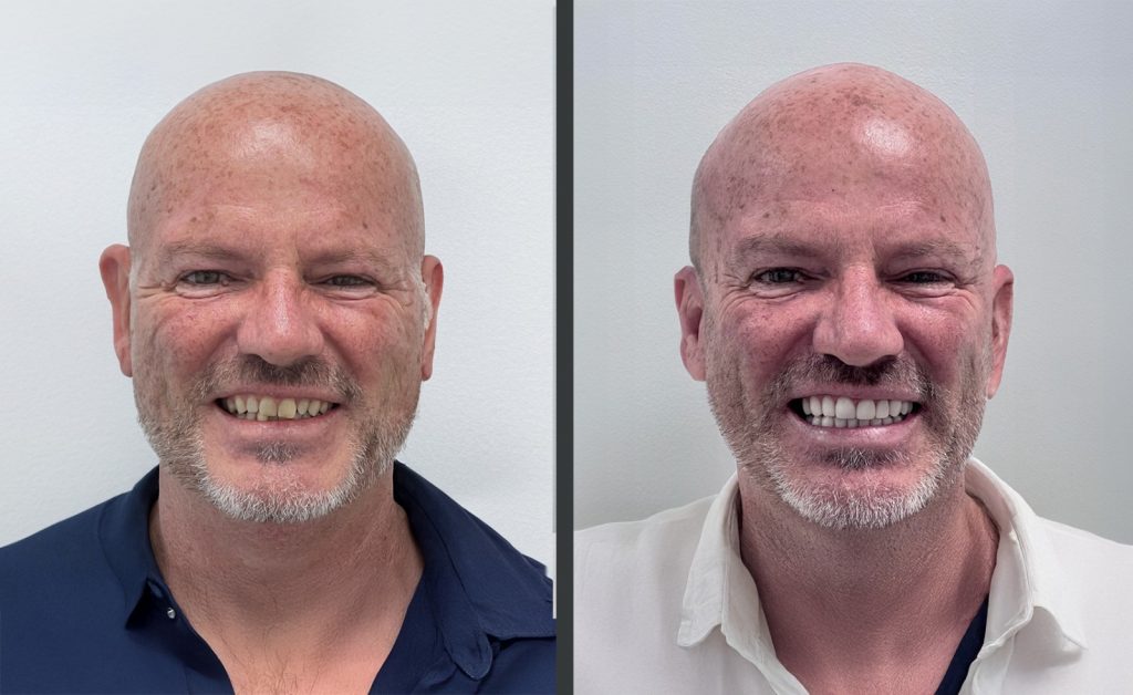 Antes Y Después Carillas 3