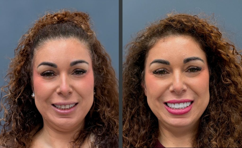 Antes Y Después Carillas 5