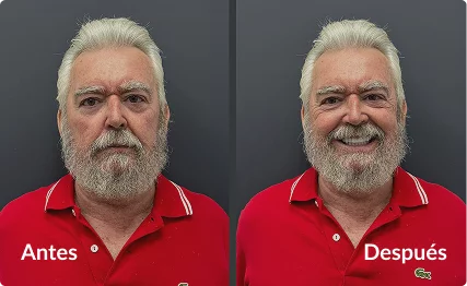 Antes y después de rehabilitación oral completa en paciente masculino – Grupo Dental Clinics