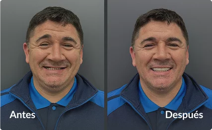 Tratamiento de implantes dentales y carillas en paciente masculino – Grupo Dental Clinics