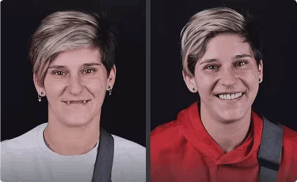 Antes Y Despues Implantes Dentales Grupo Dental Clinics 4 1