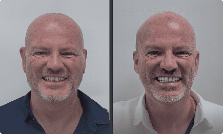Antes y después de tratamiento con carillas dentales en Grupo Dental Clinics – Hombre adulto