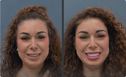 Antes y después de carillas dentales en paciente de cabello rizado – Grupo Dental Clinics