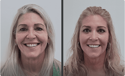 Antes y después de carillas dentales en paciente de cabello rubio – Clínica dental en Grupo Dental Clinics