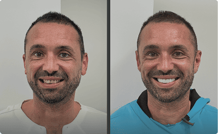 Resultado antes y después de carillas dentales en paciente masculino