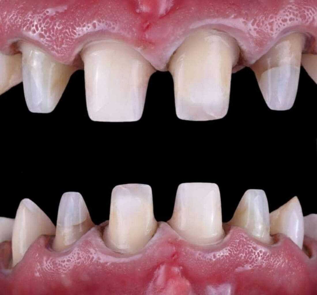 Tratamiento de carillas dentales de porcelana en Grupo Dental Clinics