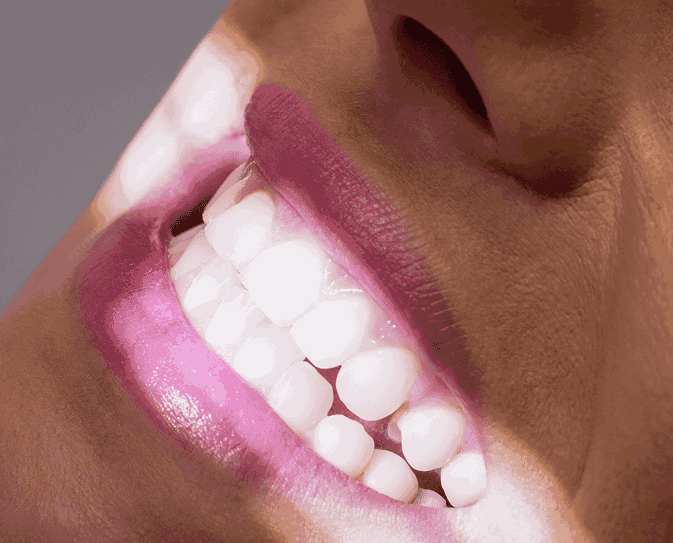 Tratamiento de carillas Dentales Composite Grupo Dental Clinics