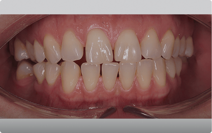 Diastema Arcos Asimétricos