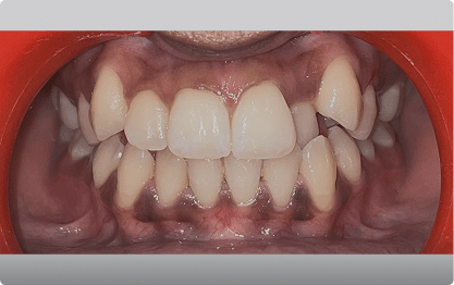Diastema Arcos Asimetricos