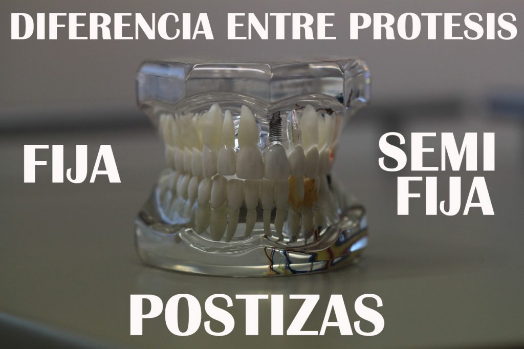 Diferencia Entre Prótesis Fija, Semifija Y Postiza