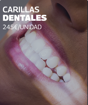 Carillas dentales