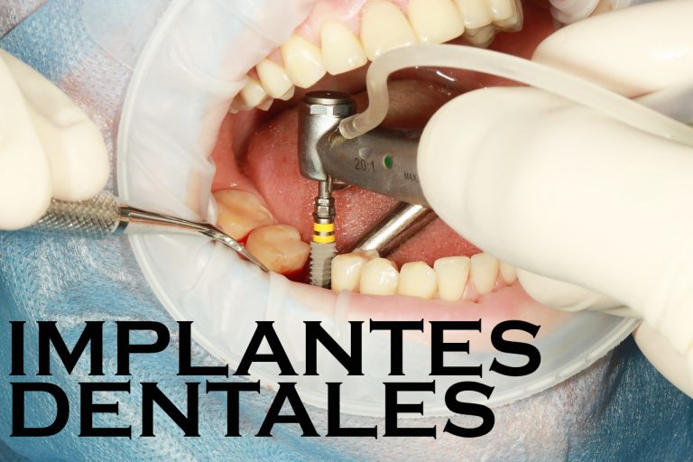 Implantes Dentales