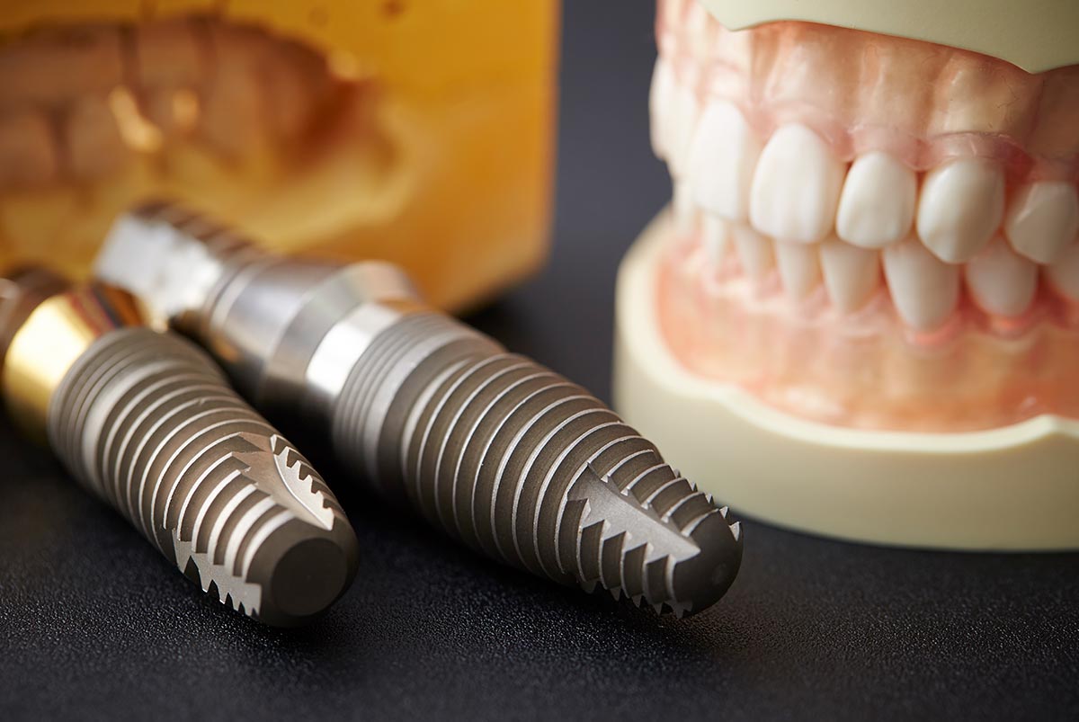 Implantes Dentales 2