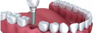 Implantes Dentales 3