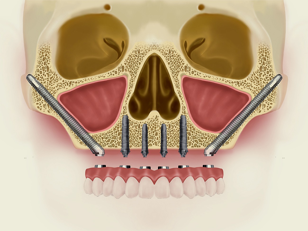 Implantes-dentales_5-1.jpg