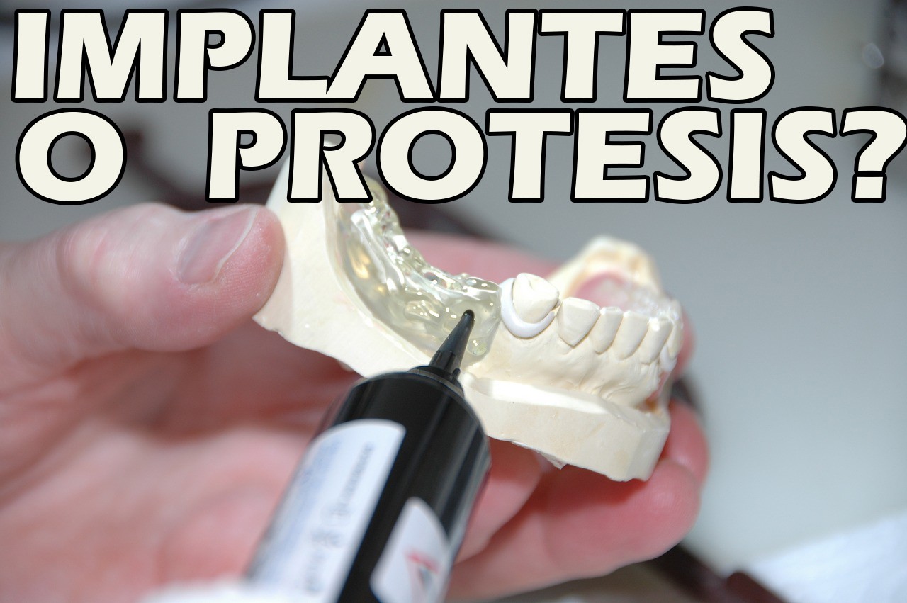 Implantes O Protesis Dental