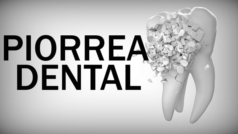 Qué Es La Piorrea Dental