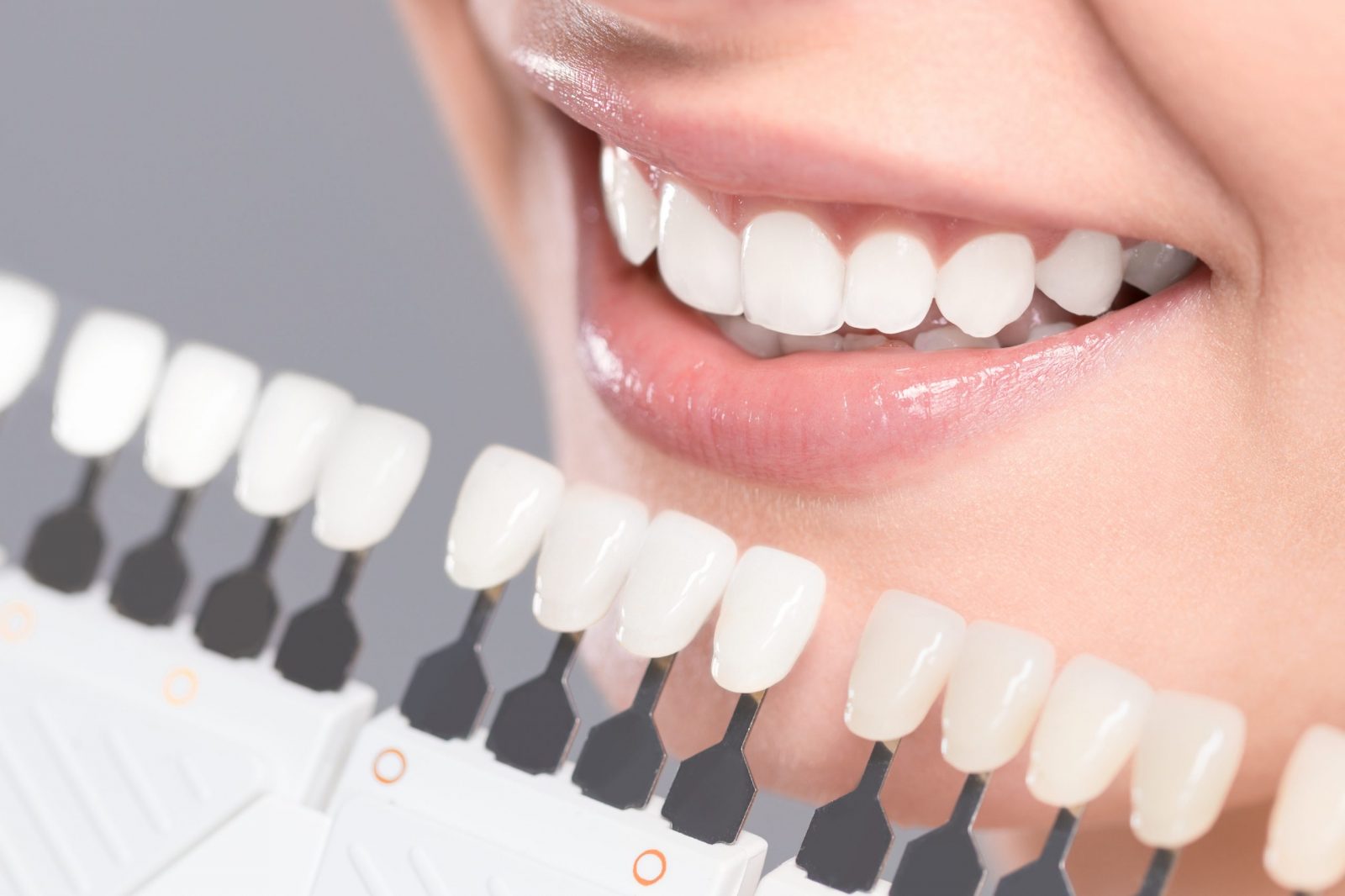 Sonrisa bonita de una mujer jóven tras su tratamiento de carillas de composite o de porcelana con Grupo Dental Clinics