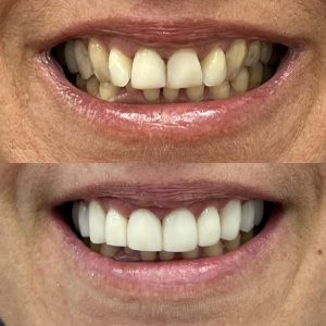 Carillas Dentales Grupo Dental Clinics