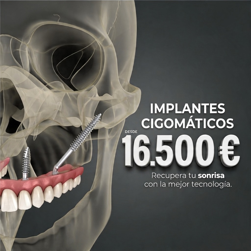 implantes cigomaticos