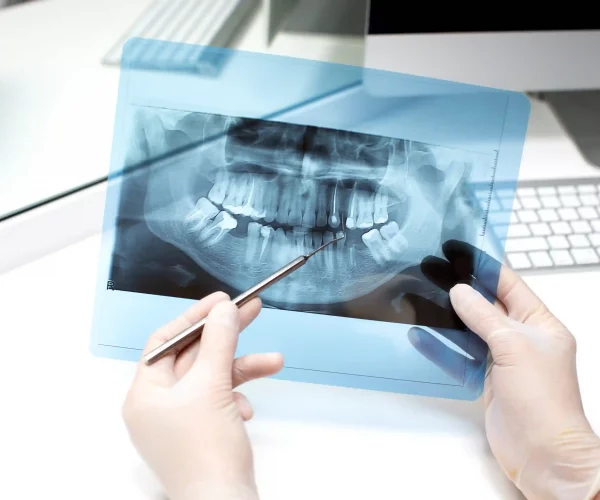 Riesgos Y Desventajas De Los Implantes Cigomáticos (1)2