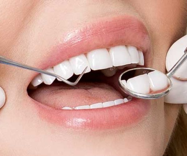 Carillas dentales de composite vs de porcelana, ¿Cuál elegir? Tratamientos especializados en Grupo Dental Clinics