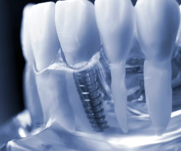 ¿los Implantes Dentales Producen Cáncer2