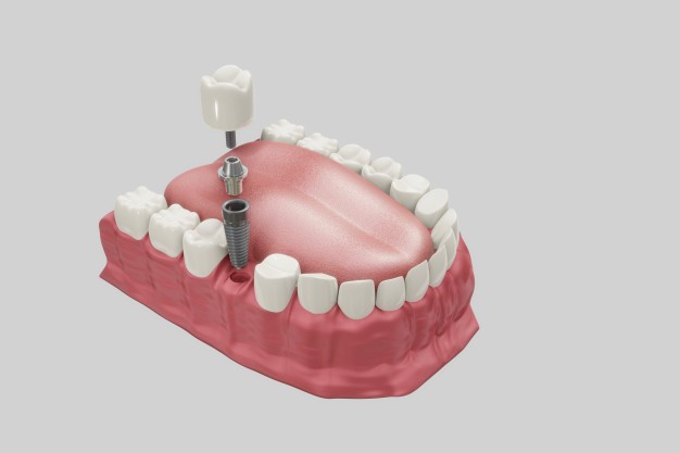 procedimiento-tratamiento-implantes-dentales-concepto-protesis-ilustracion-3d-medicamente-precisa_44282-154.jpg