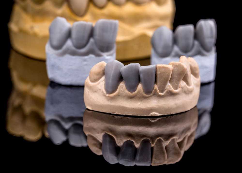 Modelos de prótesis dental fija, semifija y removible sobre base dental, utilizados para mostrar las diferencias entre tipos de prótesis en Grupo Dental Clinics.